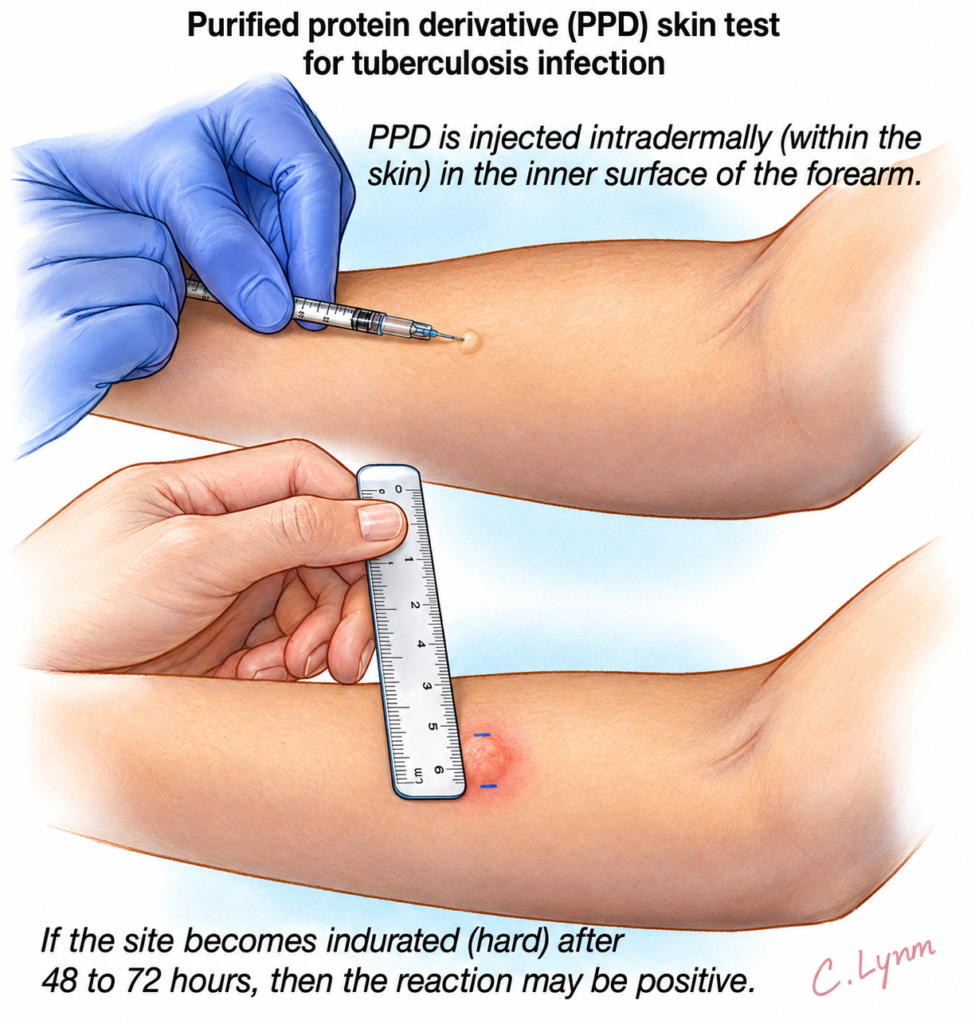 Tuberculosis Nursing Management